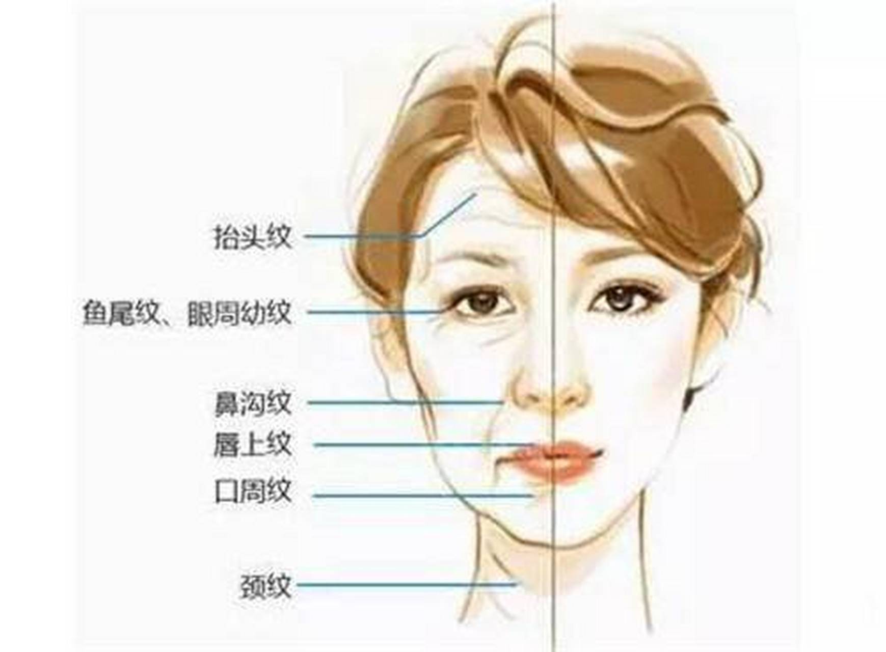 其实这些去川字纹,鱼尾纹,抬头纹的除皱针,还有瘦脸针,本质上,都是