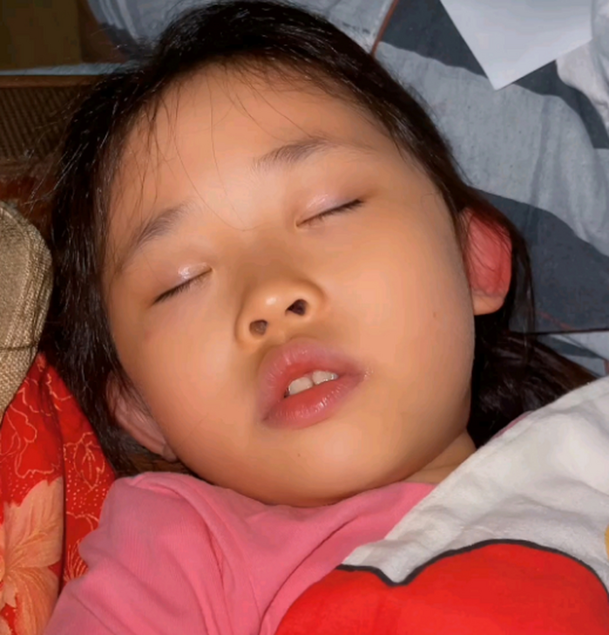 腺样体面容就是腺样体肥大导致的.