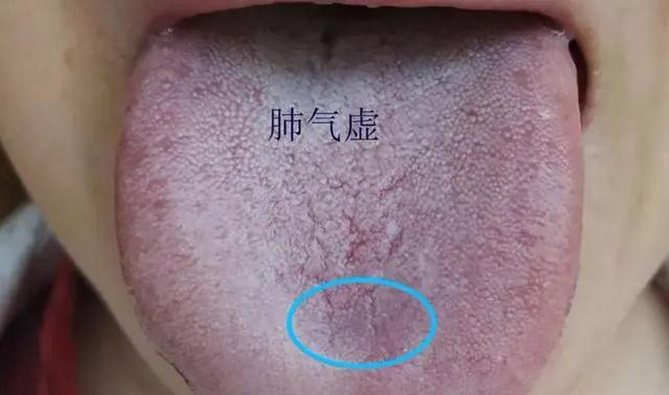 舌头有裂纹,你虚的不止一点 1,肺阴不足:裂纹容易出现在前1/3或者说舌