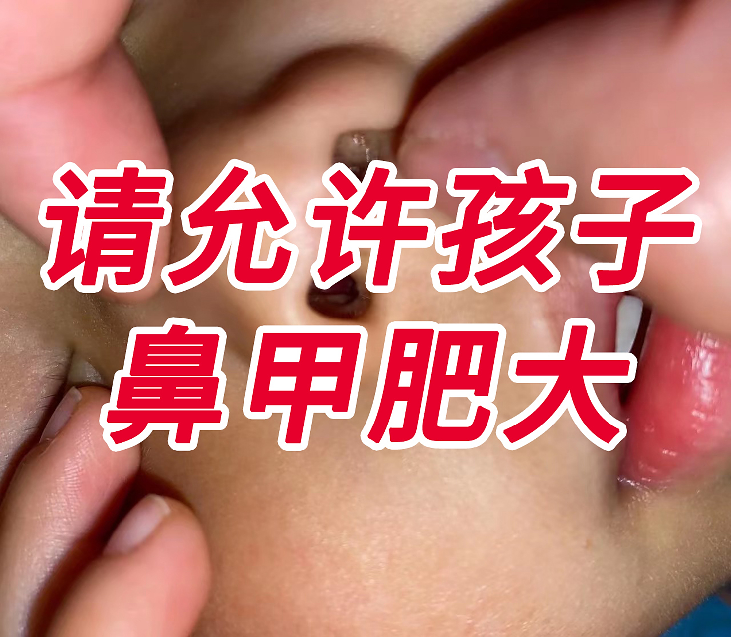 近两年接诊了太多鼻炎鼻甲肥大的孩子,有句话憋在心里很久了:孩子