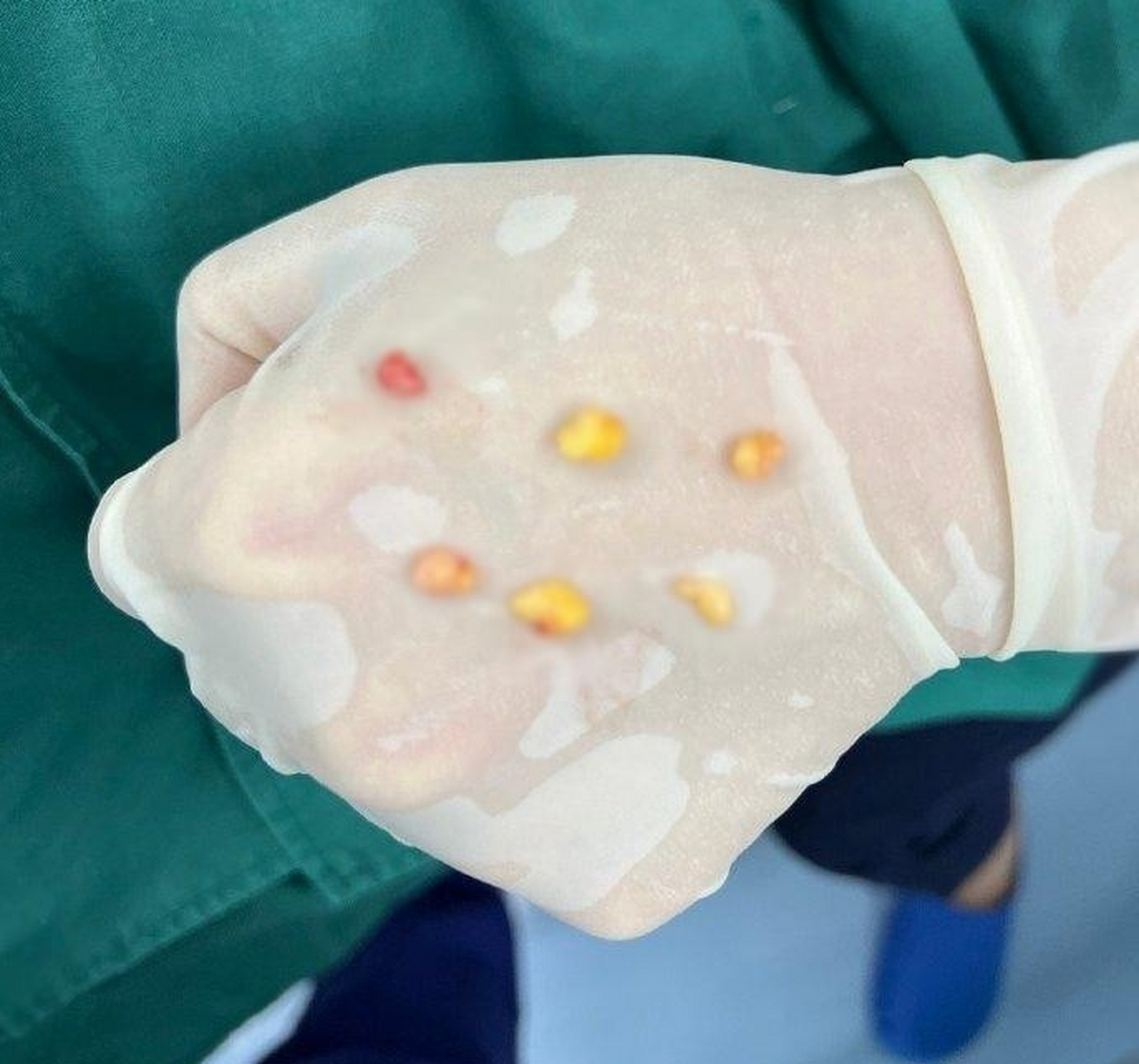 你别看眼袋小小的,里面的脂肪并不少.