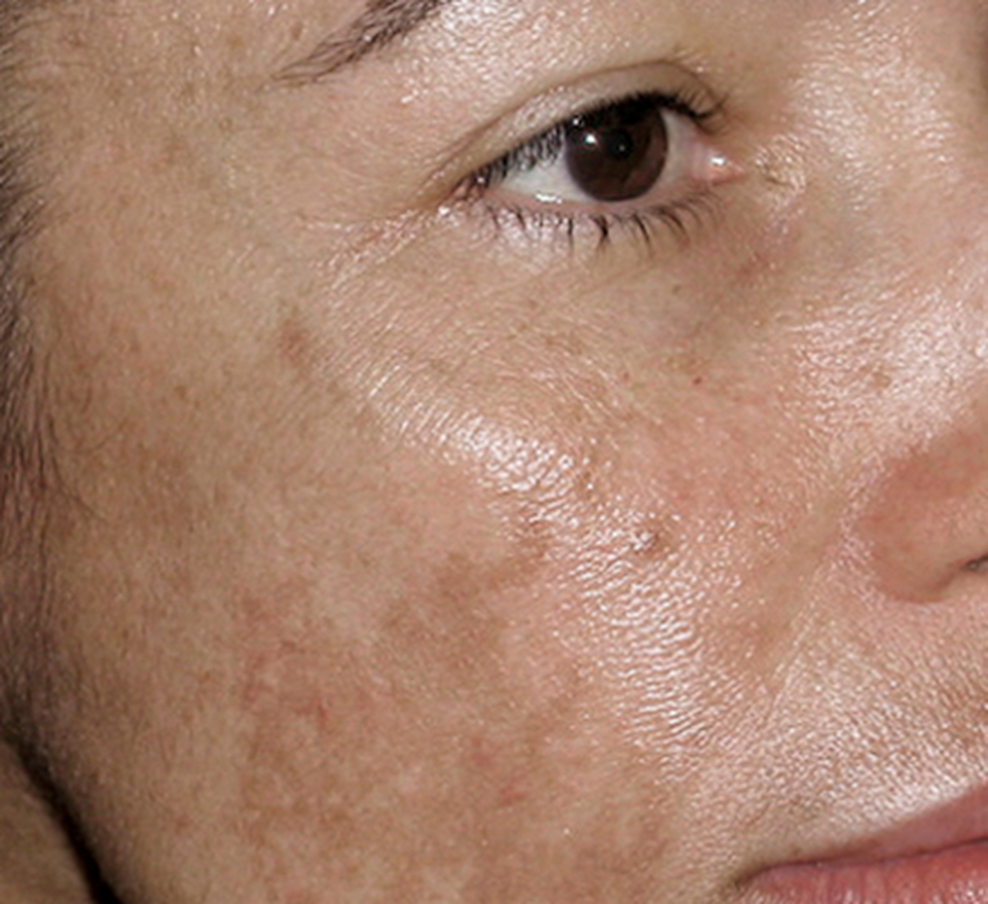 黄褐斑,其实是一种身体向你发出的求救信号.