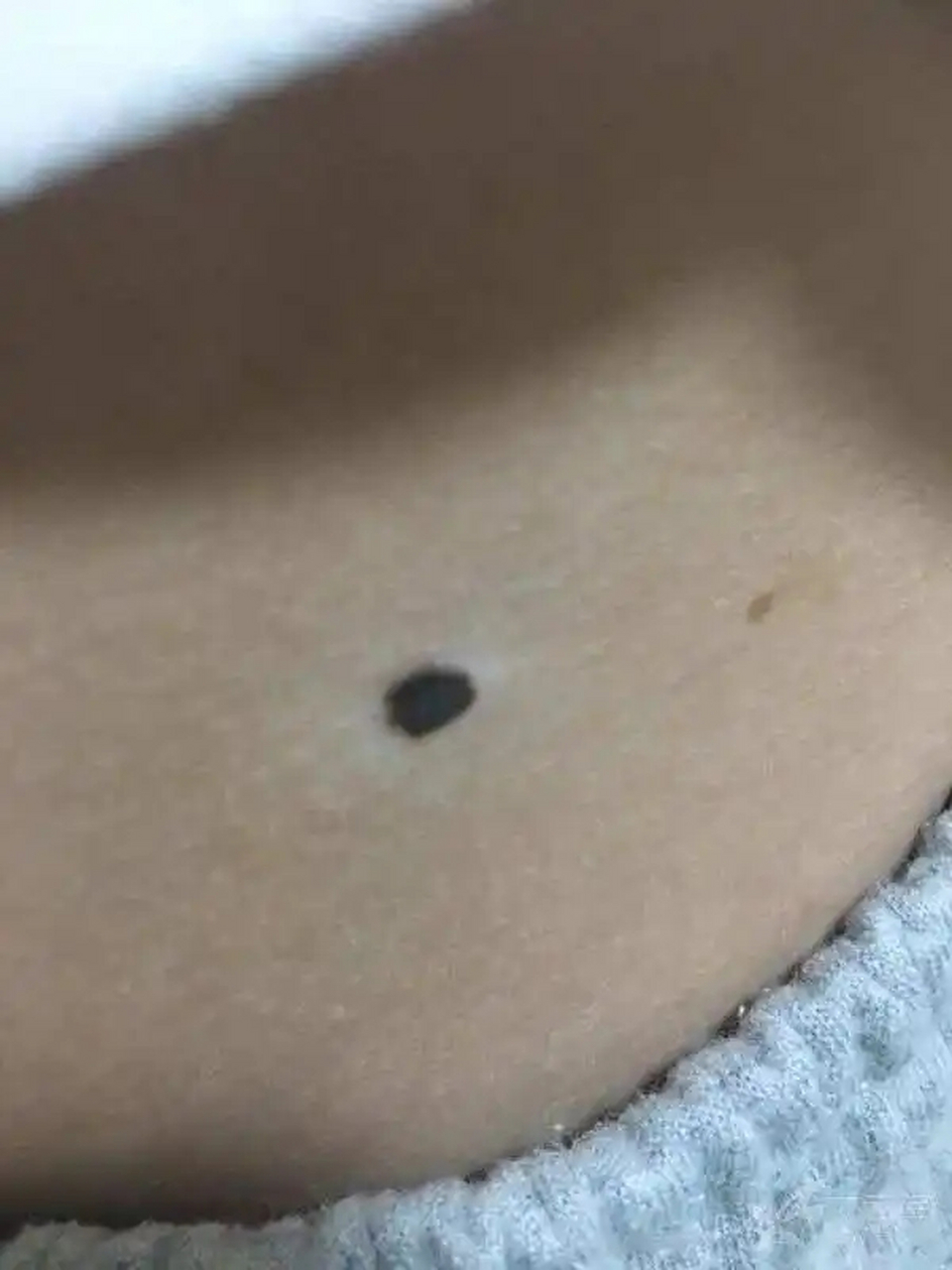 晕痣的治疗,白斑没有什么争议,按照白癜风去处理和治疗.