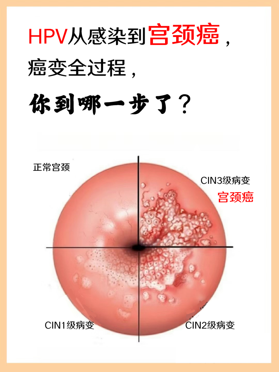 hpv从感染到宫颈癌,癌变全过程,你到哪一步了?