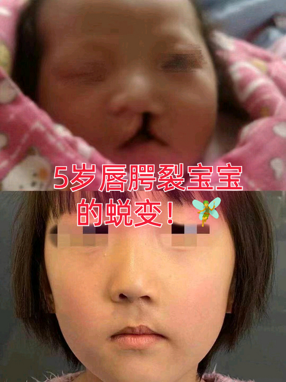 唇裂5毫米出生后样子图片