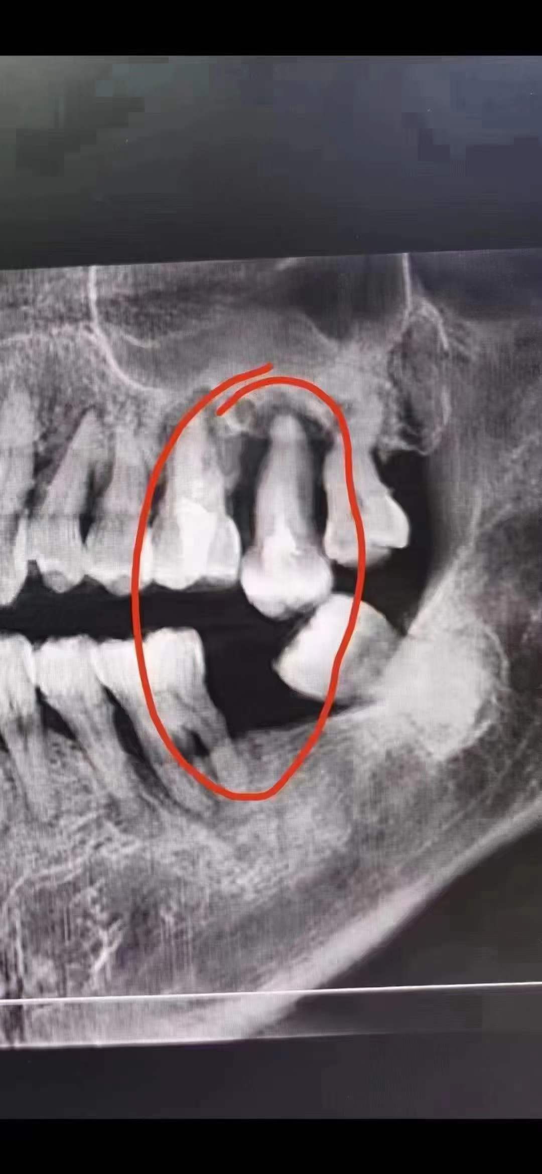 牙齿长期缺失不补,对颌牙伸长至脱落真不是危言耸听!