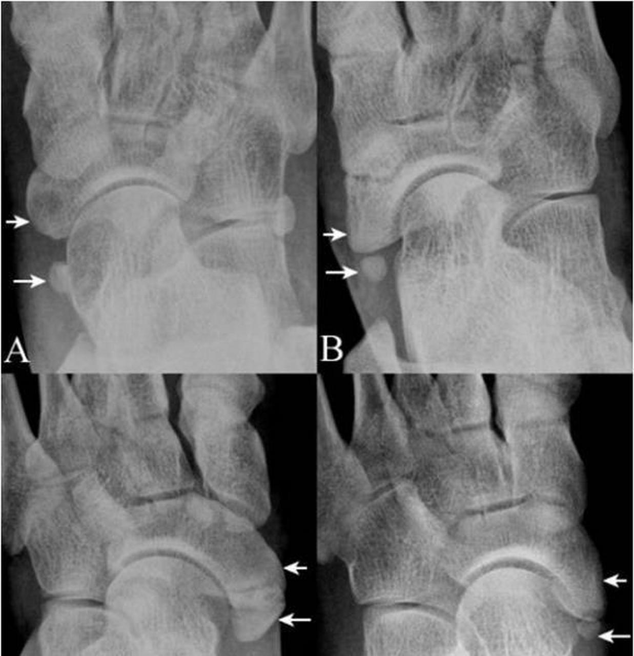 足部x线正常解剖与病变影像
