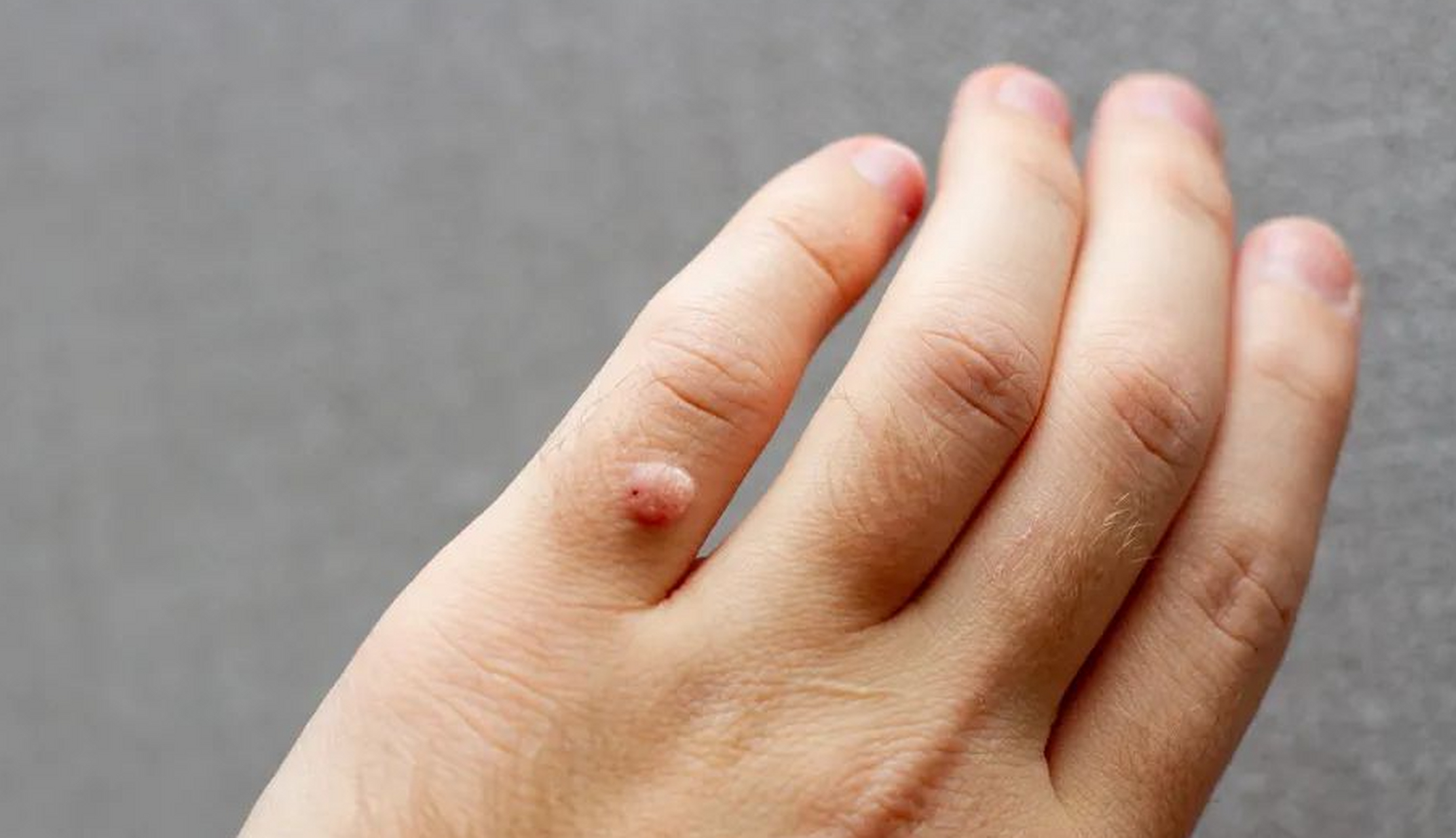 男性感染hpv,会出现什么变化?