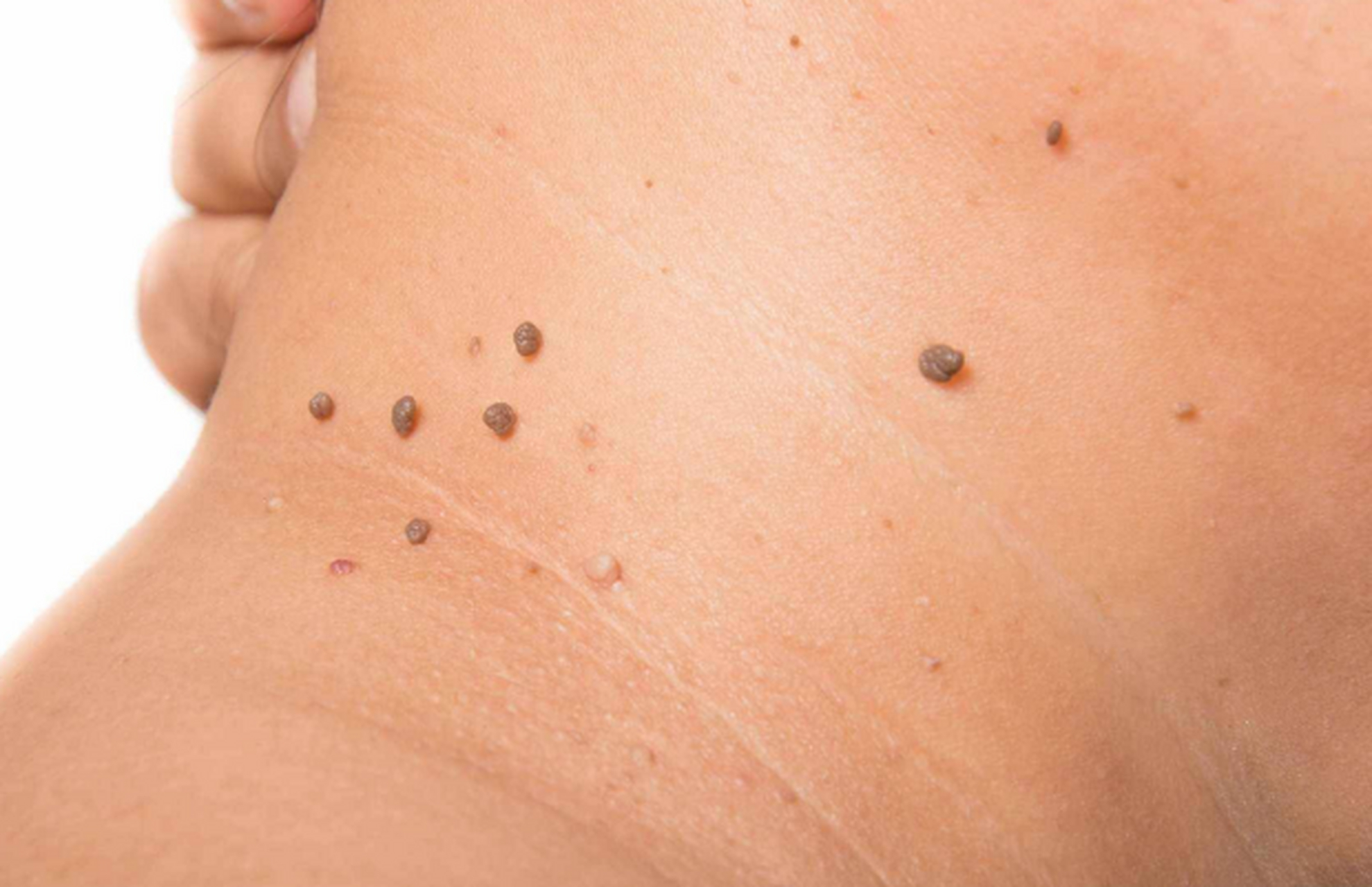 不论男女,身上长出这5种"瘊子",或已感染hpv病毒!千万别轻视!