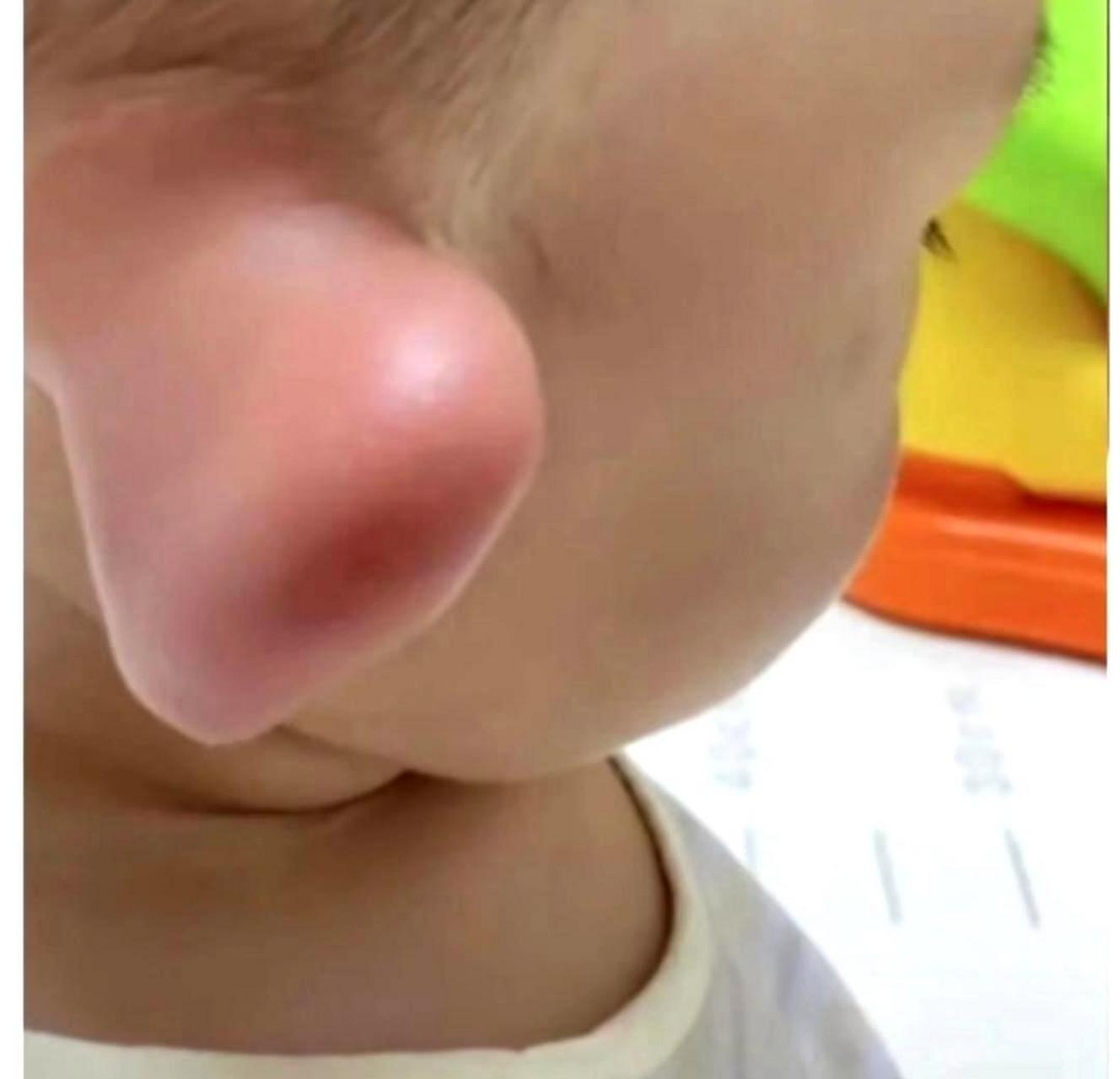 我不知道是哪只蜜蜂咬了我儿子的耳朵,结果他的耳朵肿得像个大耳朵怪