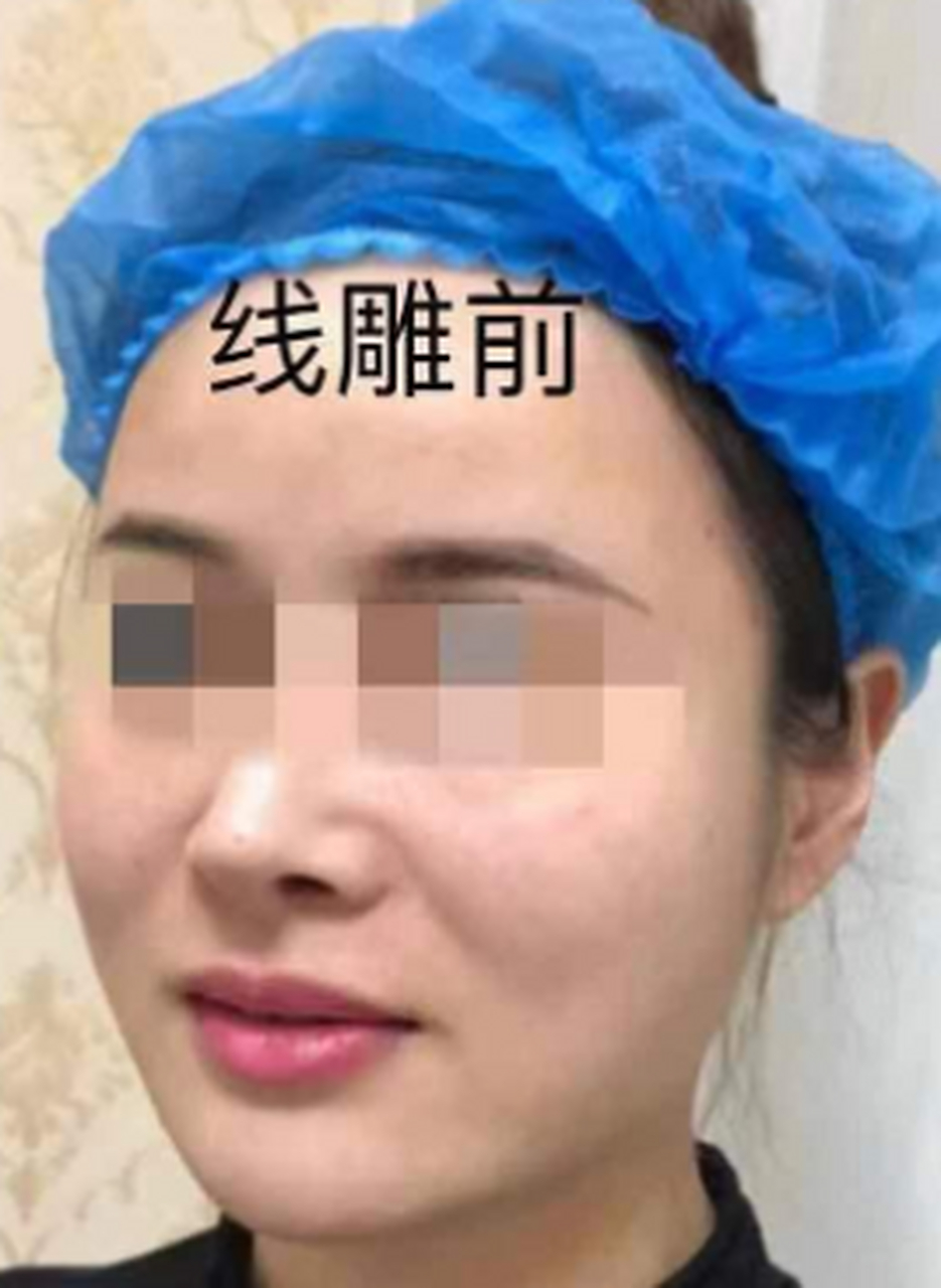 大家都知道线雕的好处,却没人告诉你们线雕也有副作用,今天我就来告诉