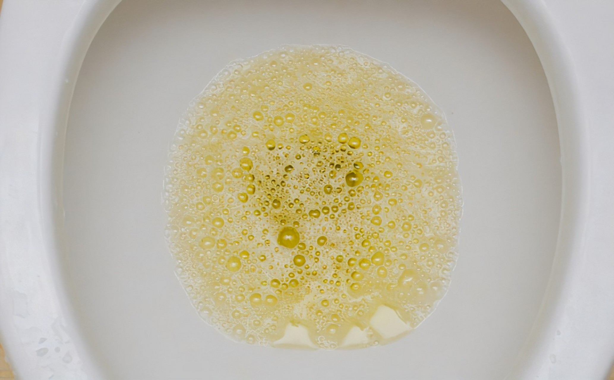 早上尿里有泡沫,是蛋白尿吗?