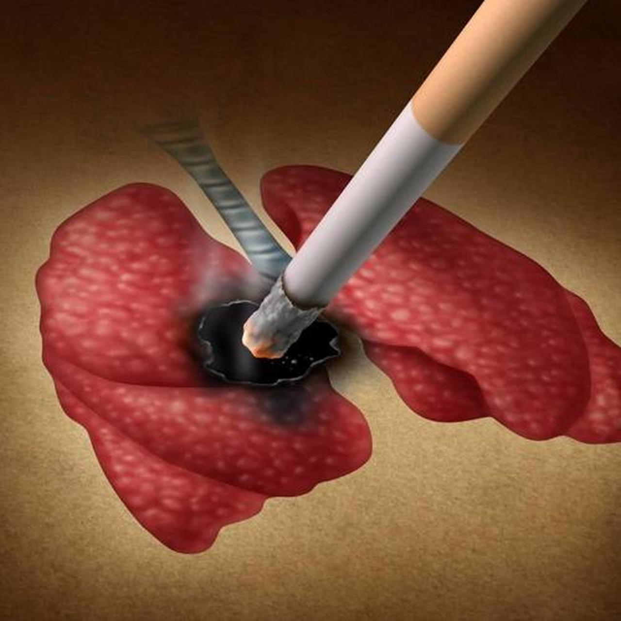 吸烟是引起慢阻肺的主要原因之一,长期的吸烟可以引起呼吸系统的阎刎