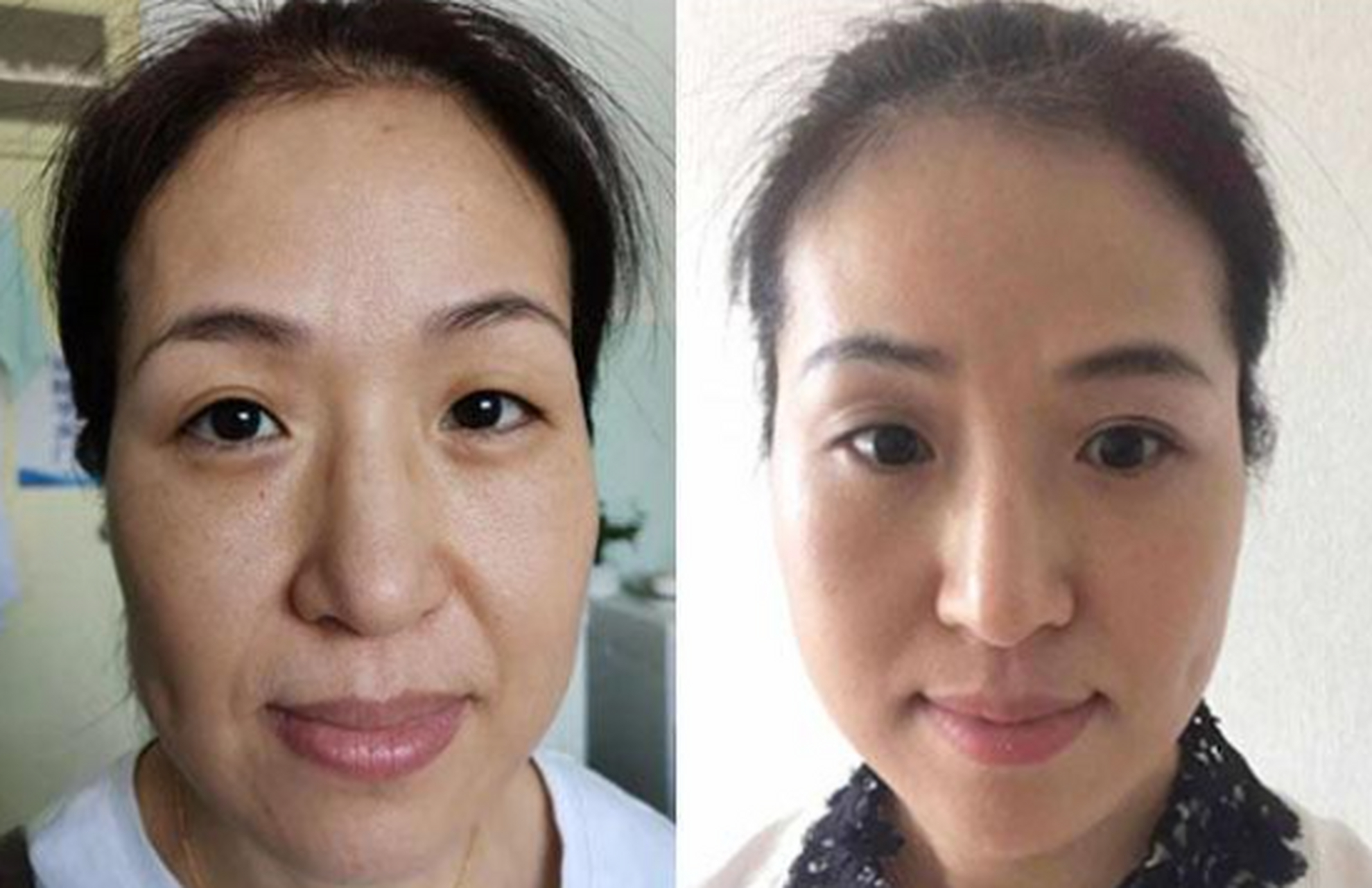 1,皮肤松弛,下垂严重的人 按面部衰老程度划分,皮肤松弛下垂严重等怂