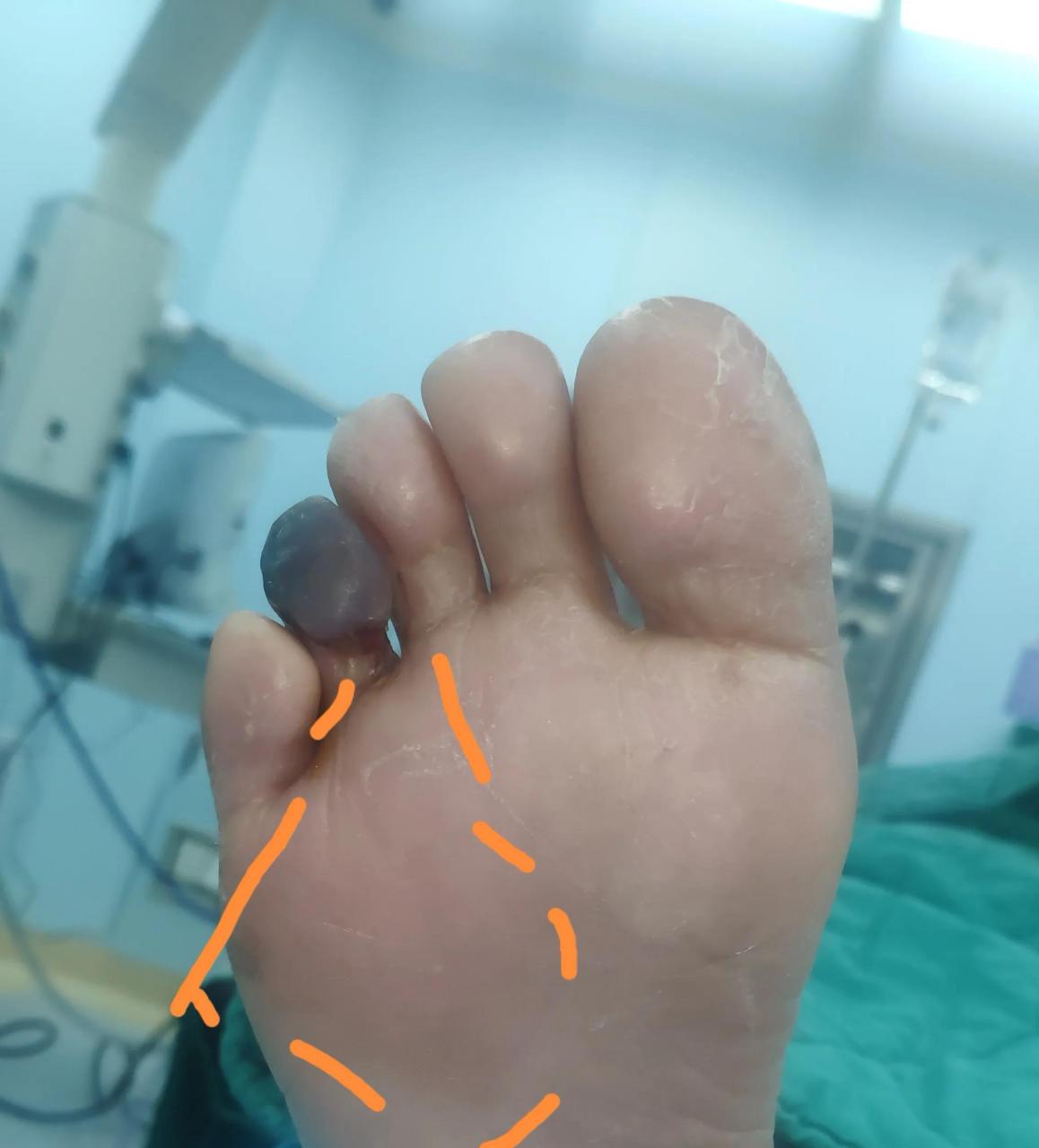 今天又做了一个糖尿病足患者的手术,右足第4足趾感染合并缺血性坏死