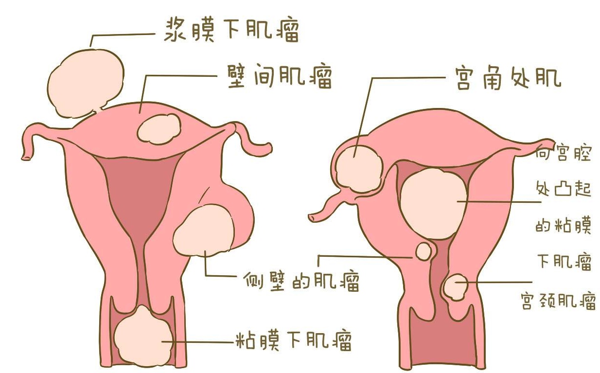 多发子宫肌瘤需要手术吗?