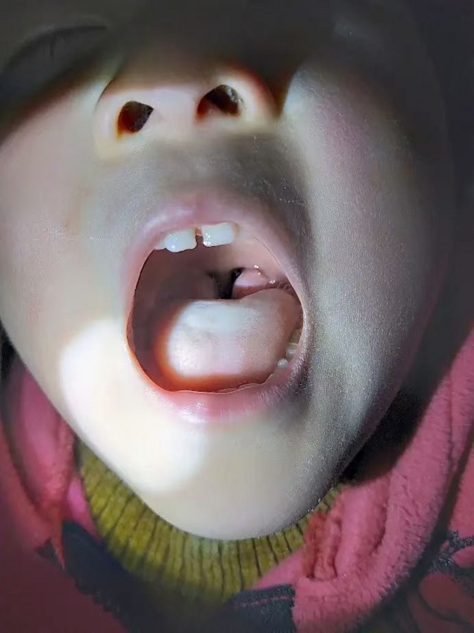 看看中医怎么治  腺样体肥大的孩子从中医上来讲,临床上常见.