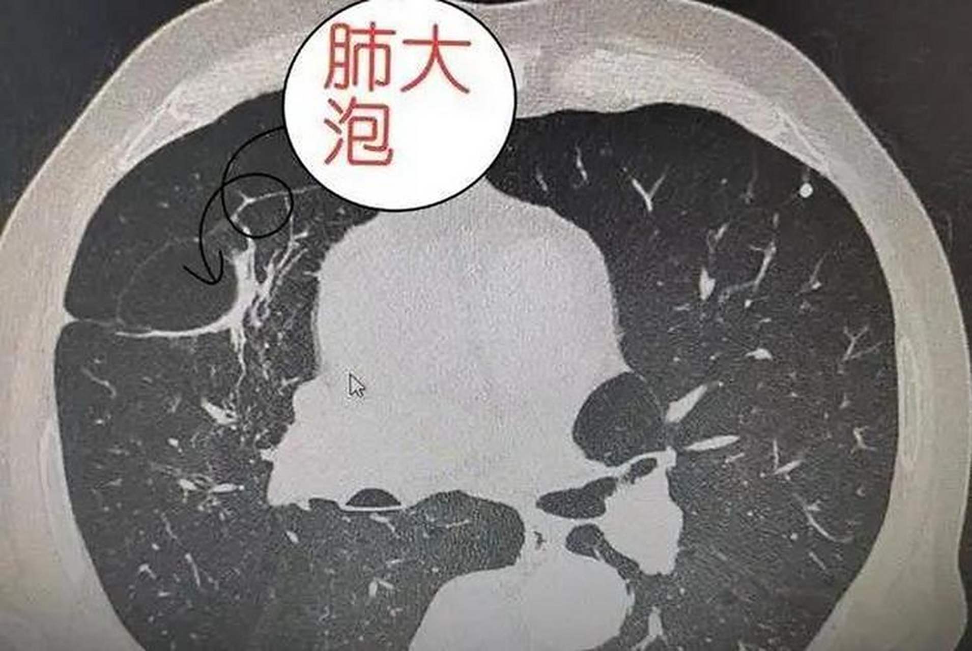 怎么做才能让肺大泡不增大呢?