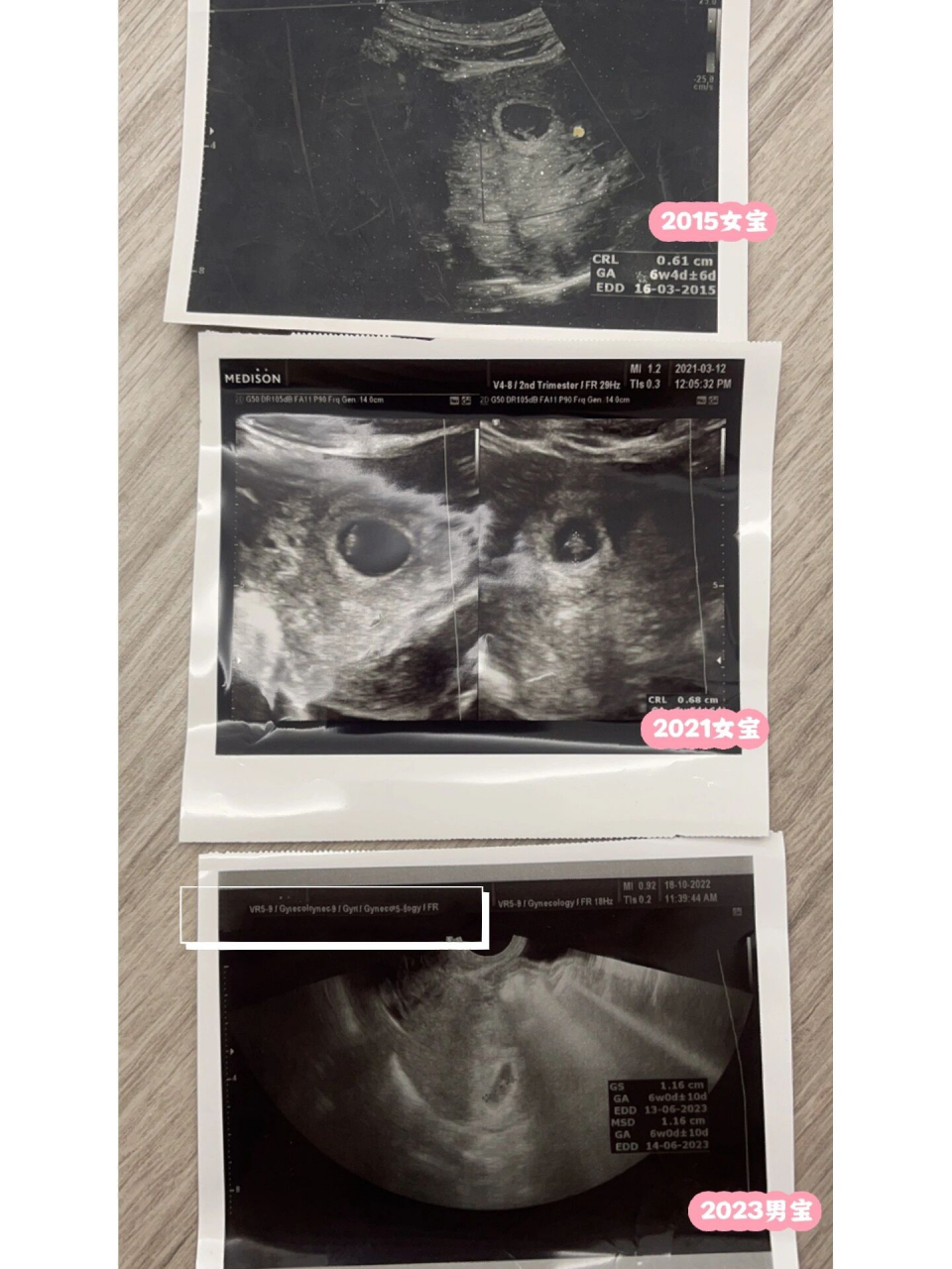 孕囊形状分辨男女宝准吗?