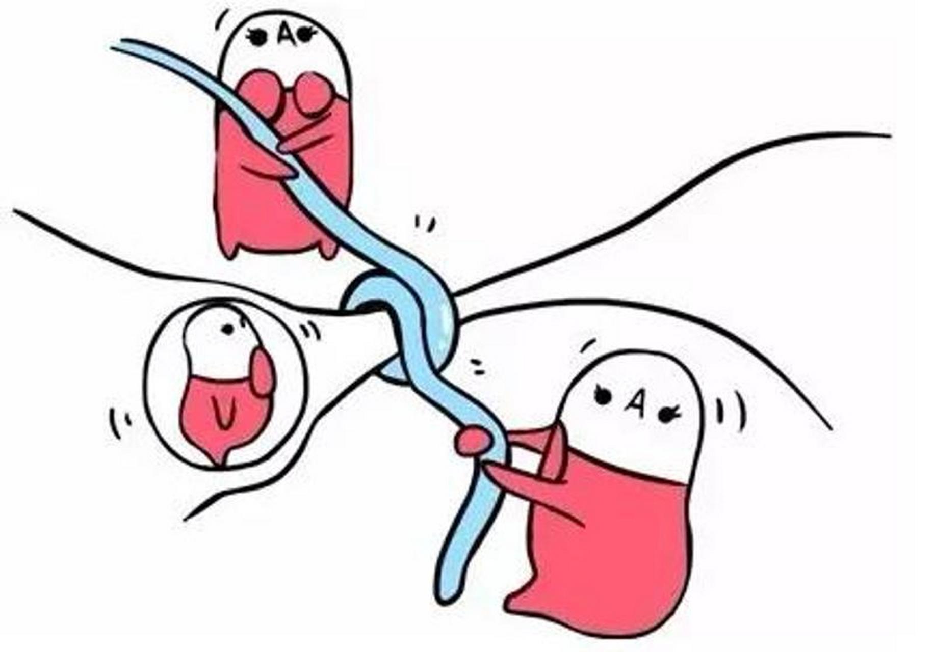 怎么看男性结扎手术 在男性避孕药尚未完全开发使用之