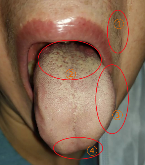 毛比较多的,多是内分泌紊乱,舌根处有大量的凸起的点,而且舌苔比较腻