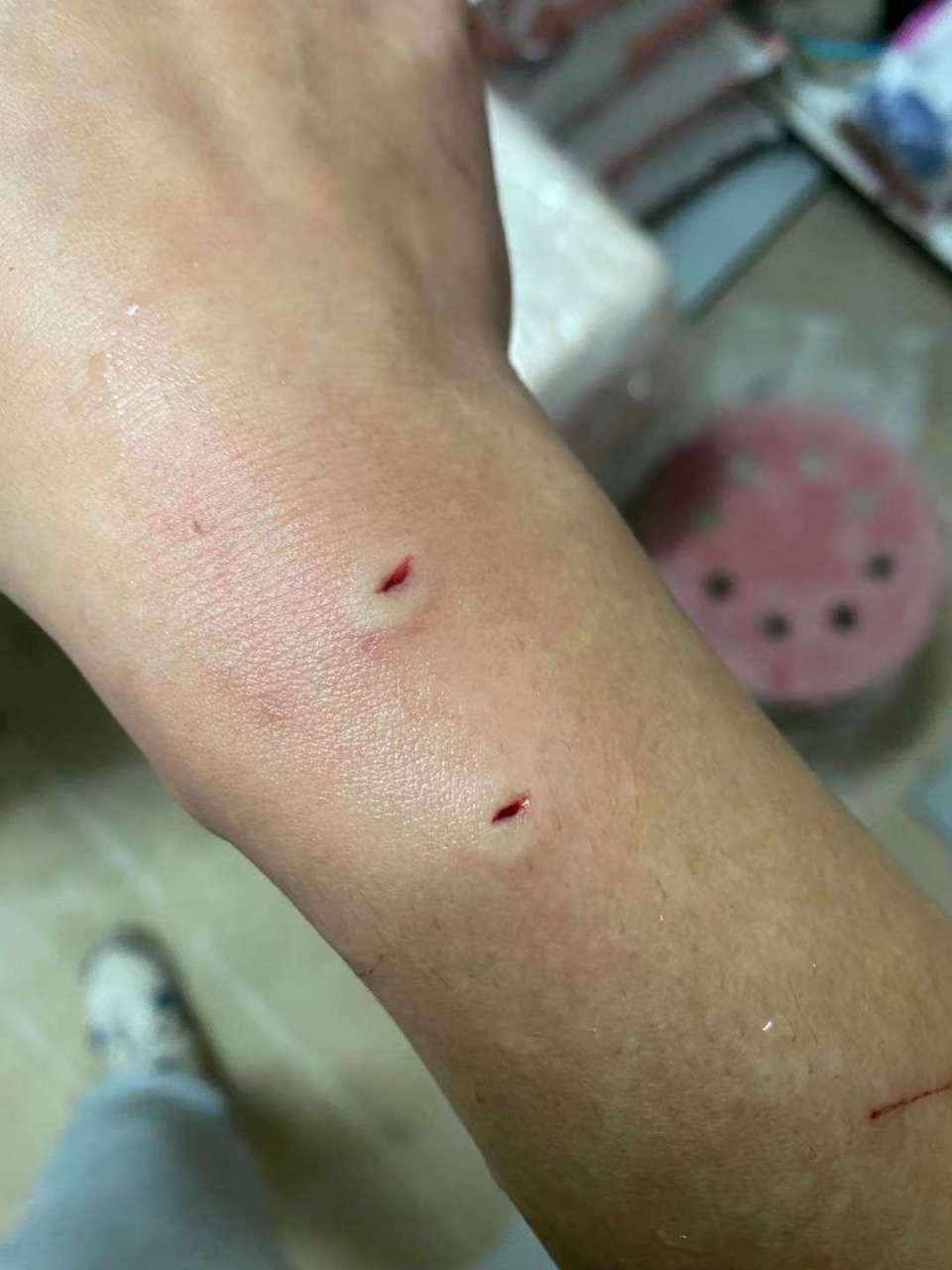 这个被咬的伤口,红花油涂一下应该没事了吧?