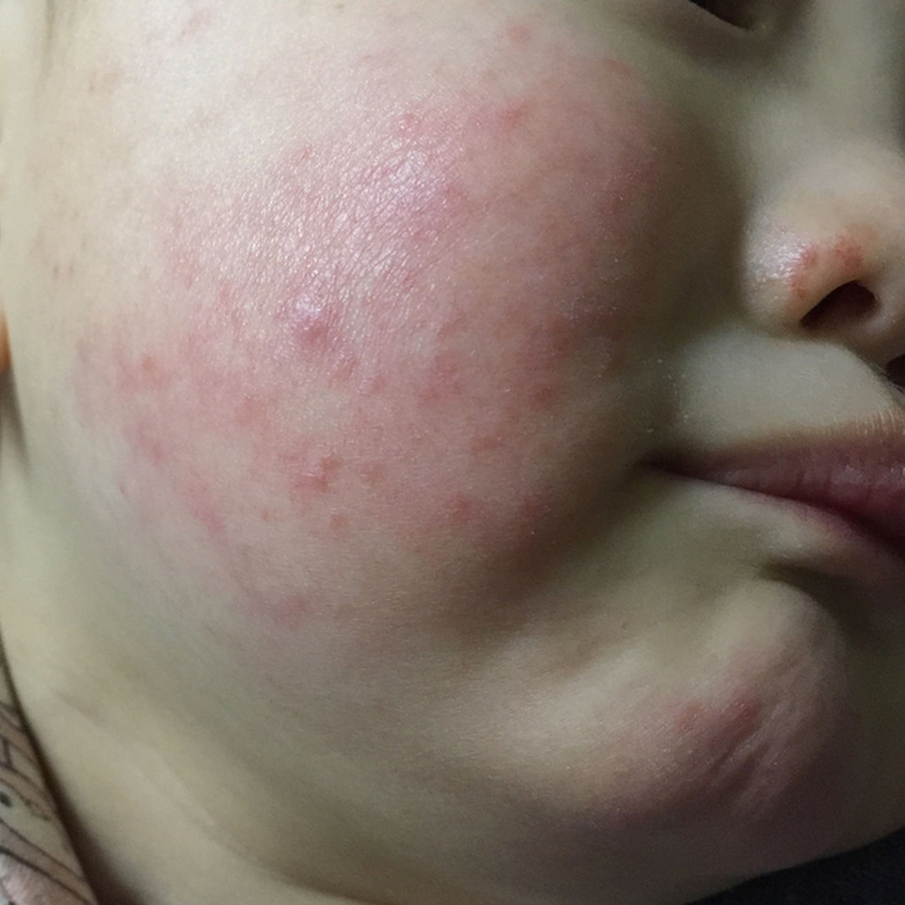 激素类药膏是可以合理用的,这也是治疗湿疹的一线用药,只要你按照