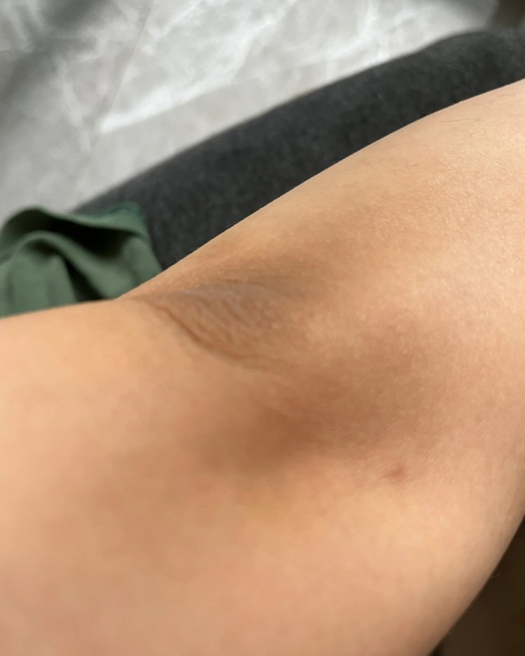 手肘是人体比较容易出现黑色素沉淀的地方,这些黑斑会让皮肤看起来很