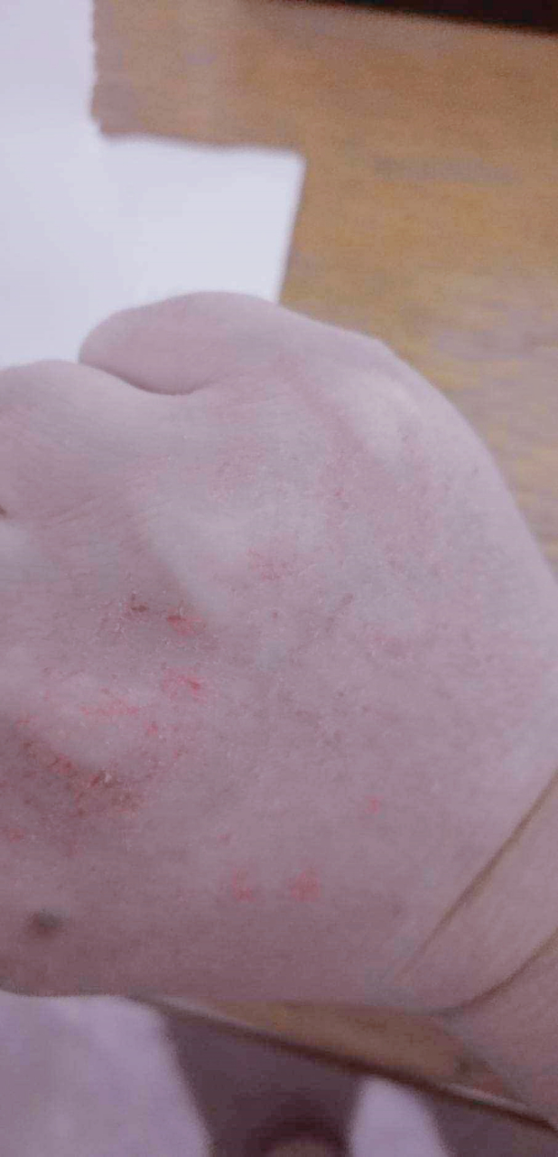 21岁女孩,一到冬天手就皴,裂口,怎么办?