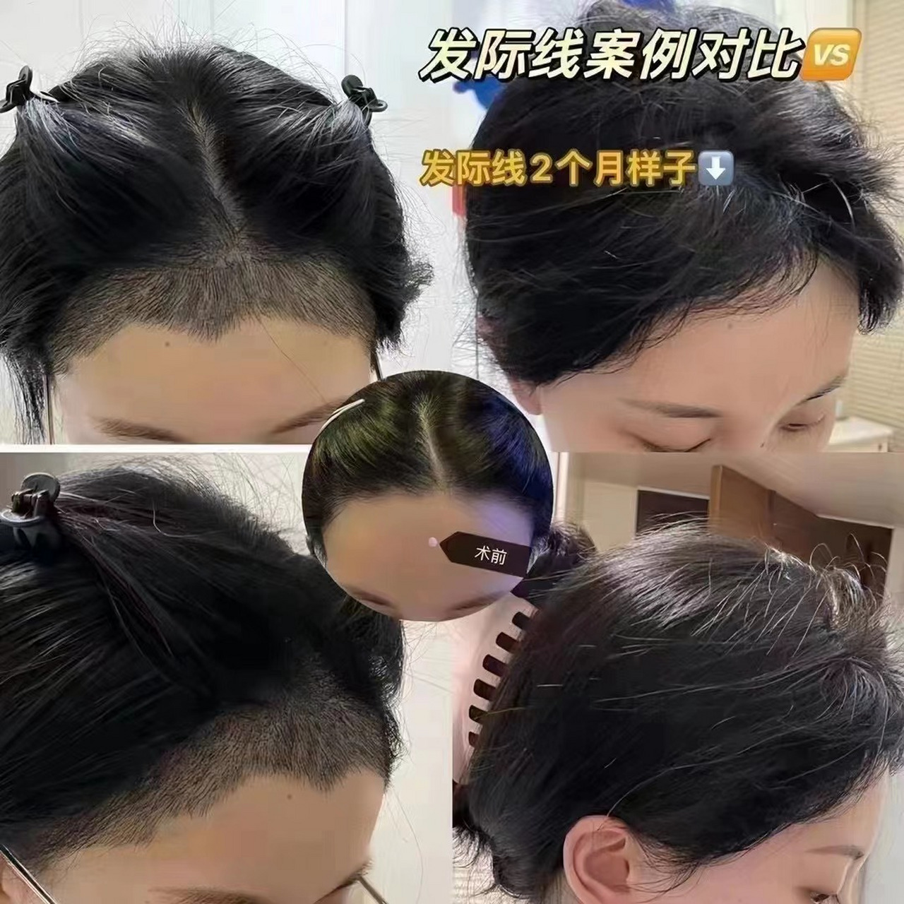 谁看了不说一句好呢 #植发际线前后对比# #头发秃顶了怎么办