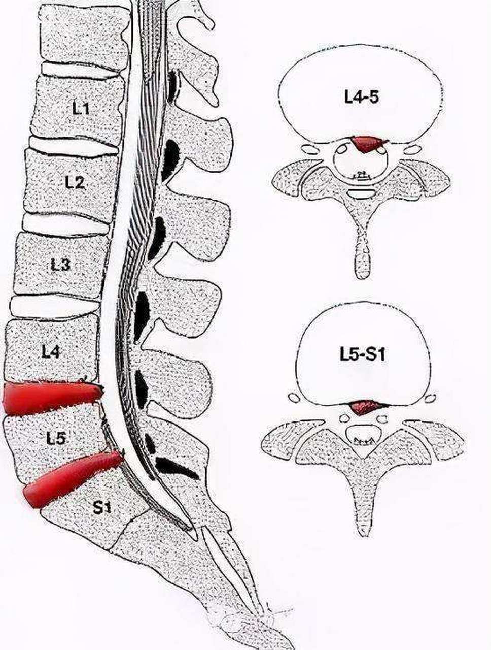 腰椎l4/5椎间盘位置图图片