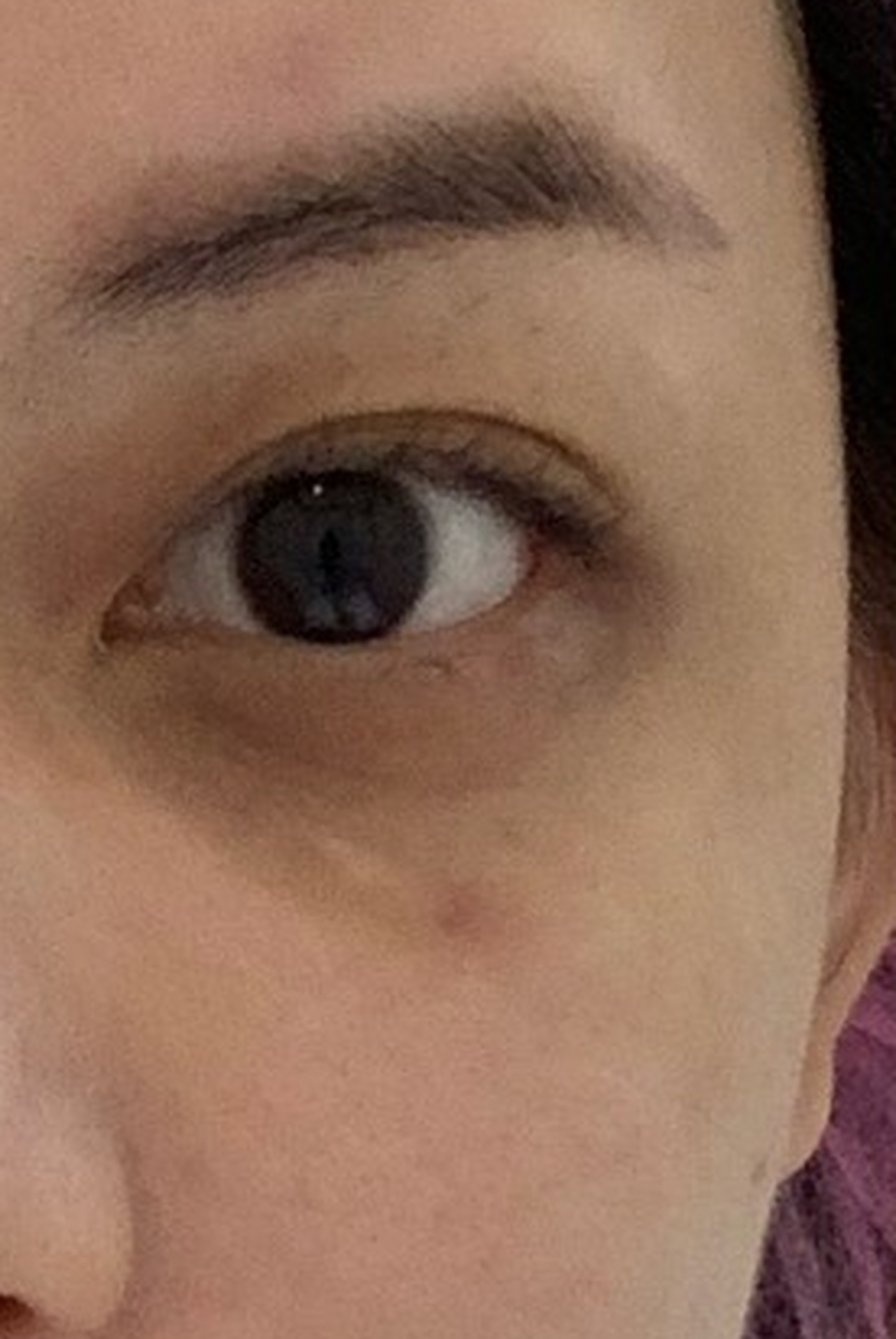 玻尿酸去黑眼圈# 想要摆脱血管型黑眼圈?没问题!