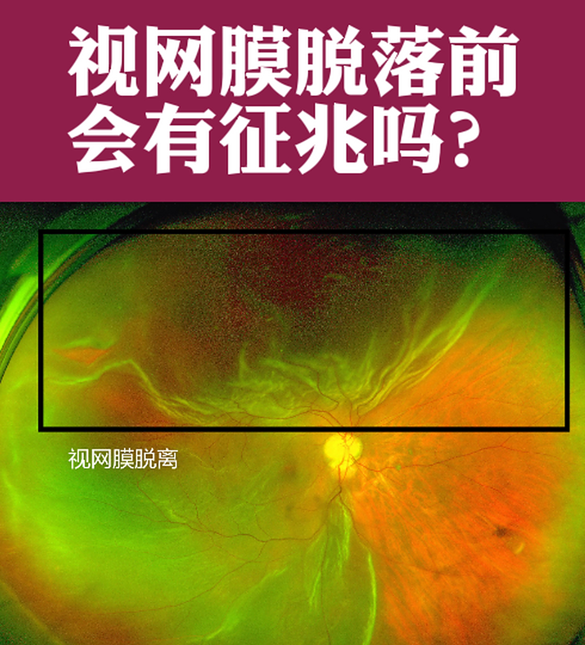 很多人经常会问我视网膜裂孔和脱离前会有什么征兆吗?