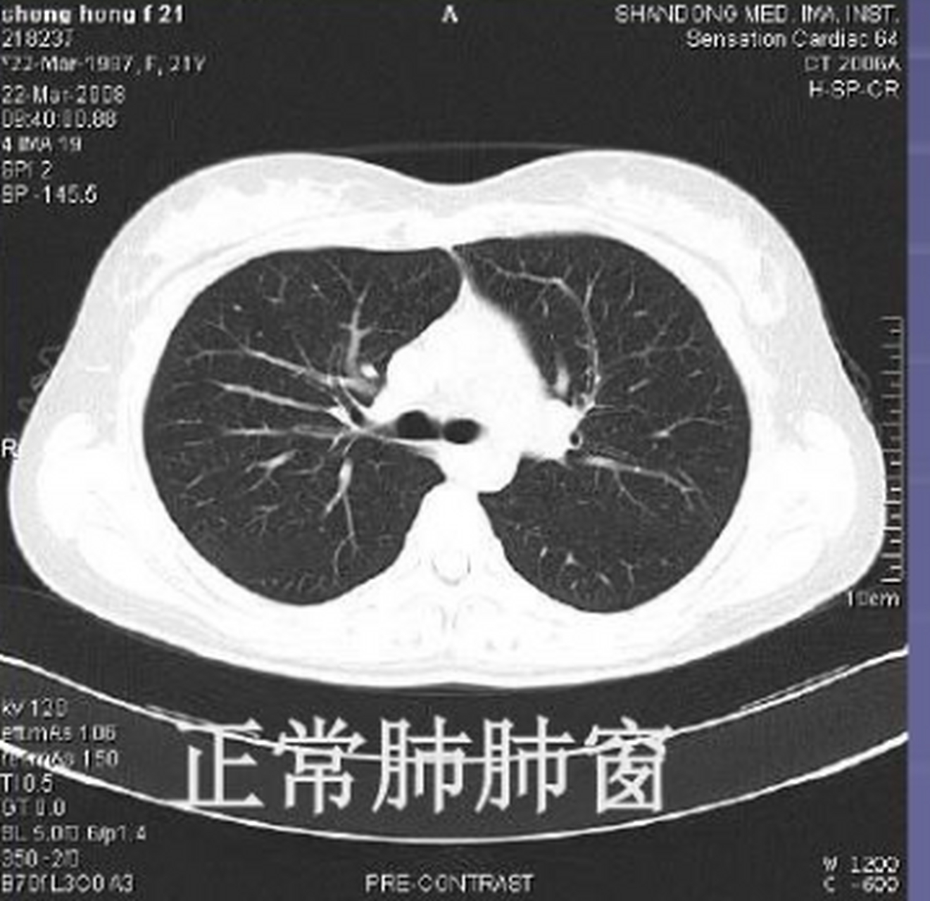 什么是磨玻璃结节? 磨玻璃样结,就是在ct片子上,像磨砂玻璃一样的.