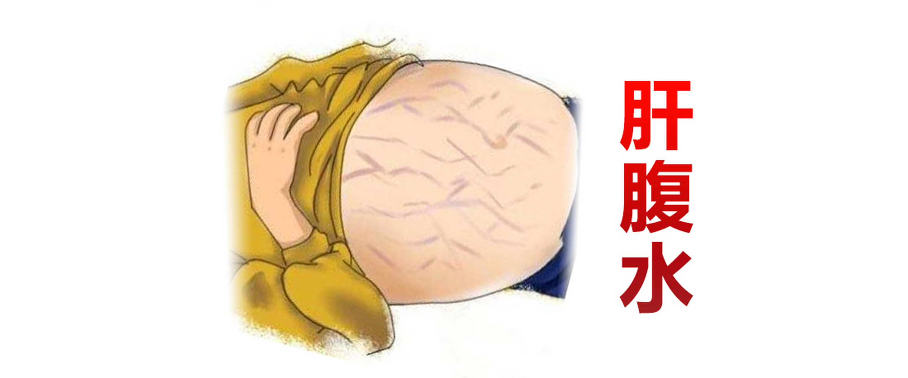 肝腹水是肝硬化晚期的一个并发症,出现的主要原因是门脉高压和低蛋白