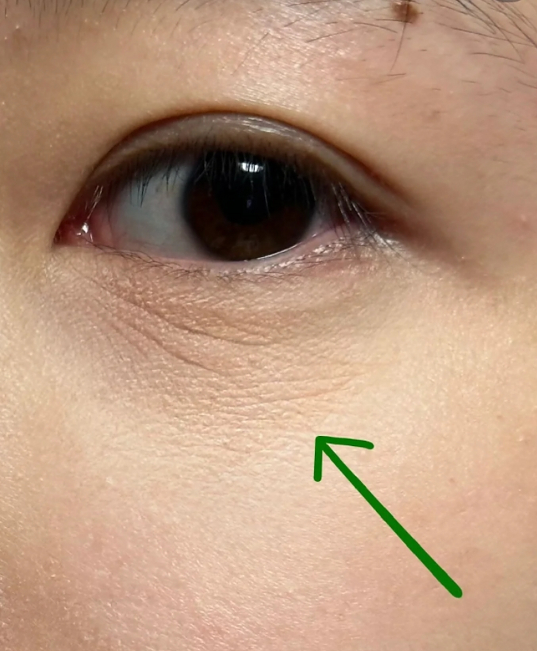 眼部干纹和细纹区别图 #医美科普挑战赛#  眼部干纹和细纹是我们常见