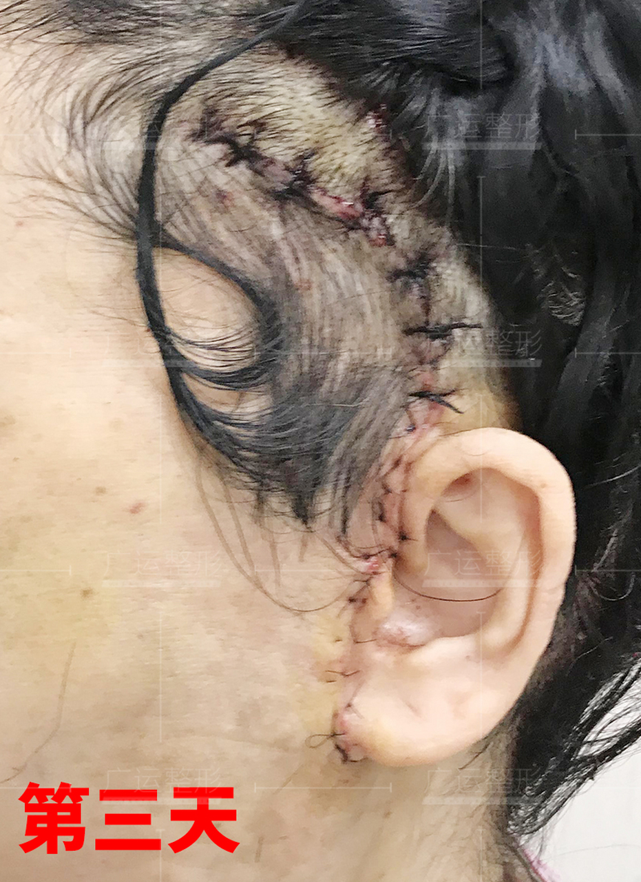 做了smas筋膜拉皮提升手术后,颞部,耳前,耳后切口恢复成什么样?