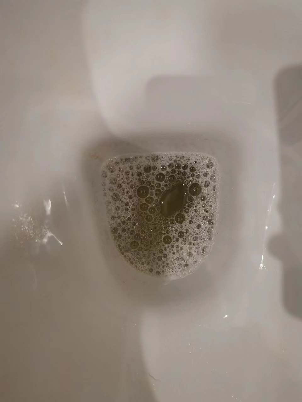 许多患者反映,尽管经过长时间的治疗,蛋白尿仍然存在,为何如此难以