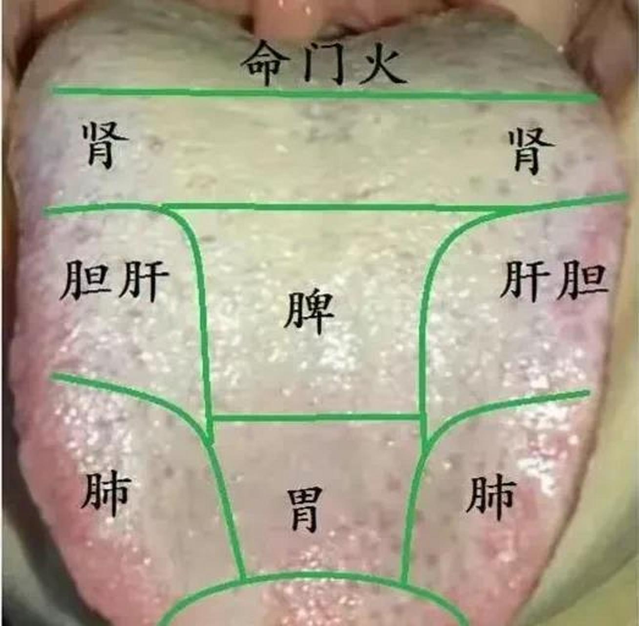 湿热内蕴,上焦心肺,中焦脾胃,下焦肝肾都有湿热,怎么办? 经常发热,各