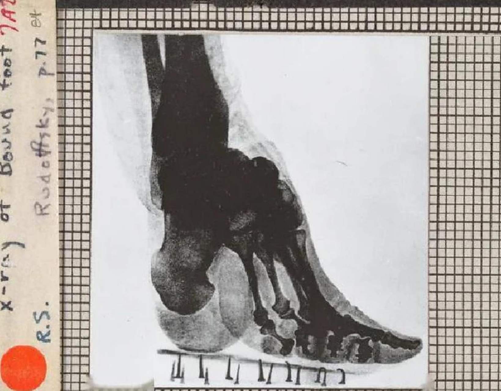 这是一张缠足女子的x光照片,从画面中可以直观地看到,她的骨头已经