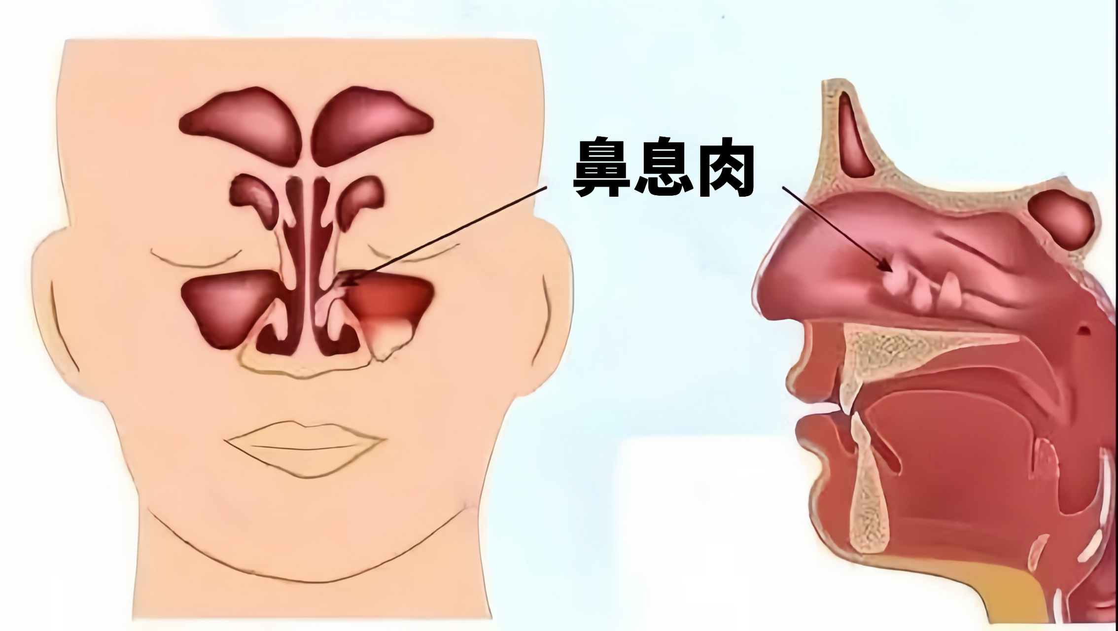 鼻息肉正面图片