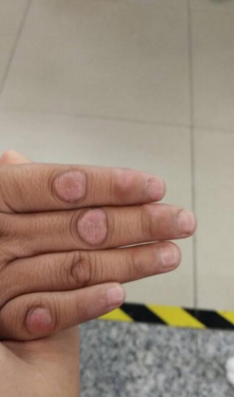 典型的指关节皮肤病[机智]  【指节垫】 皮疹:扁平或隆起的局限性角化