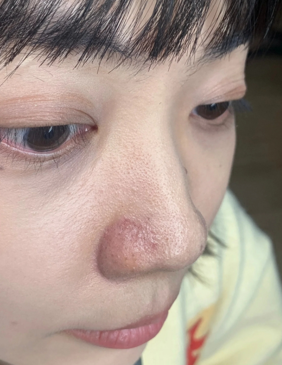 鼻子上的黑头怎么永久去掉是很多人都面临的问题,尽管它们不会对健康