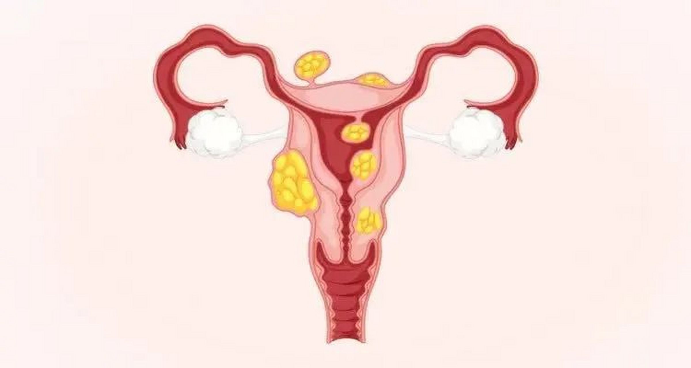 【对子宫卵巢好的食物有哪些】【子宫内膜薄是不是怀不了孕】【郑州