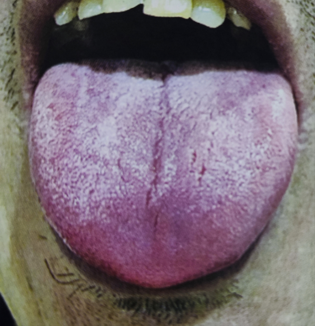 舌面无苔,养胃气很重要 这个患者是有前列腺炎,现在是胃口差,小便无力