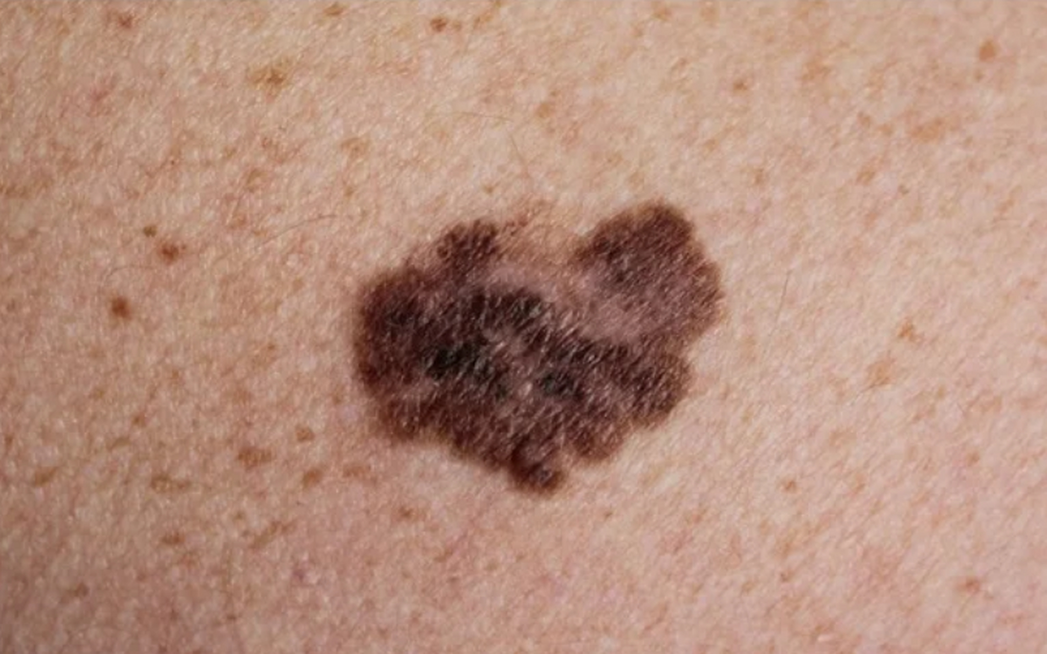 这些痣可能具有以下特征: 80颜色:黑色素瘤通常呈深棕色或黑色,但有