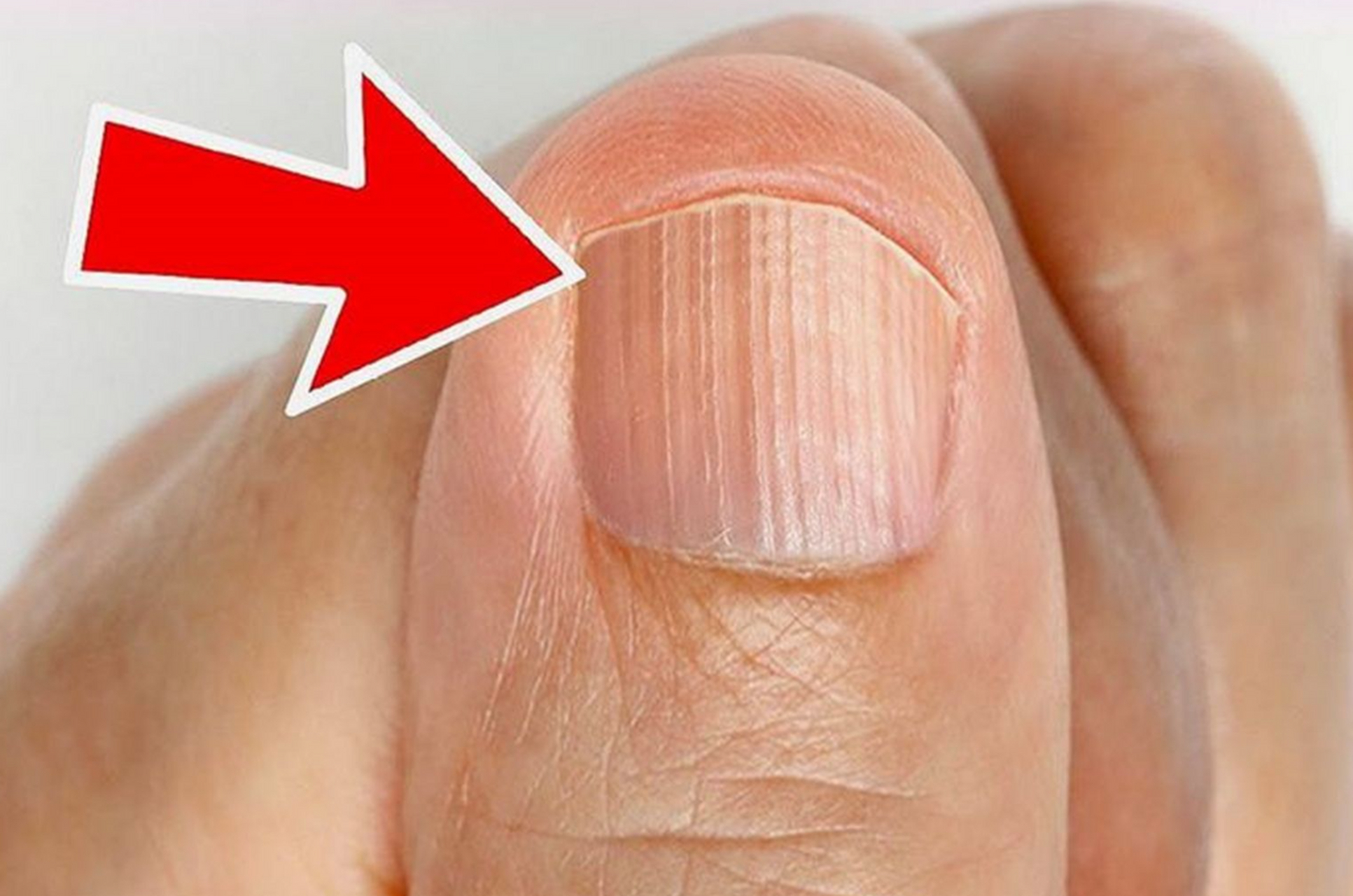 指甲有竖纹是肝癌吗?