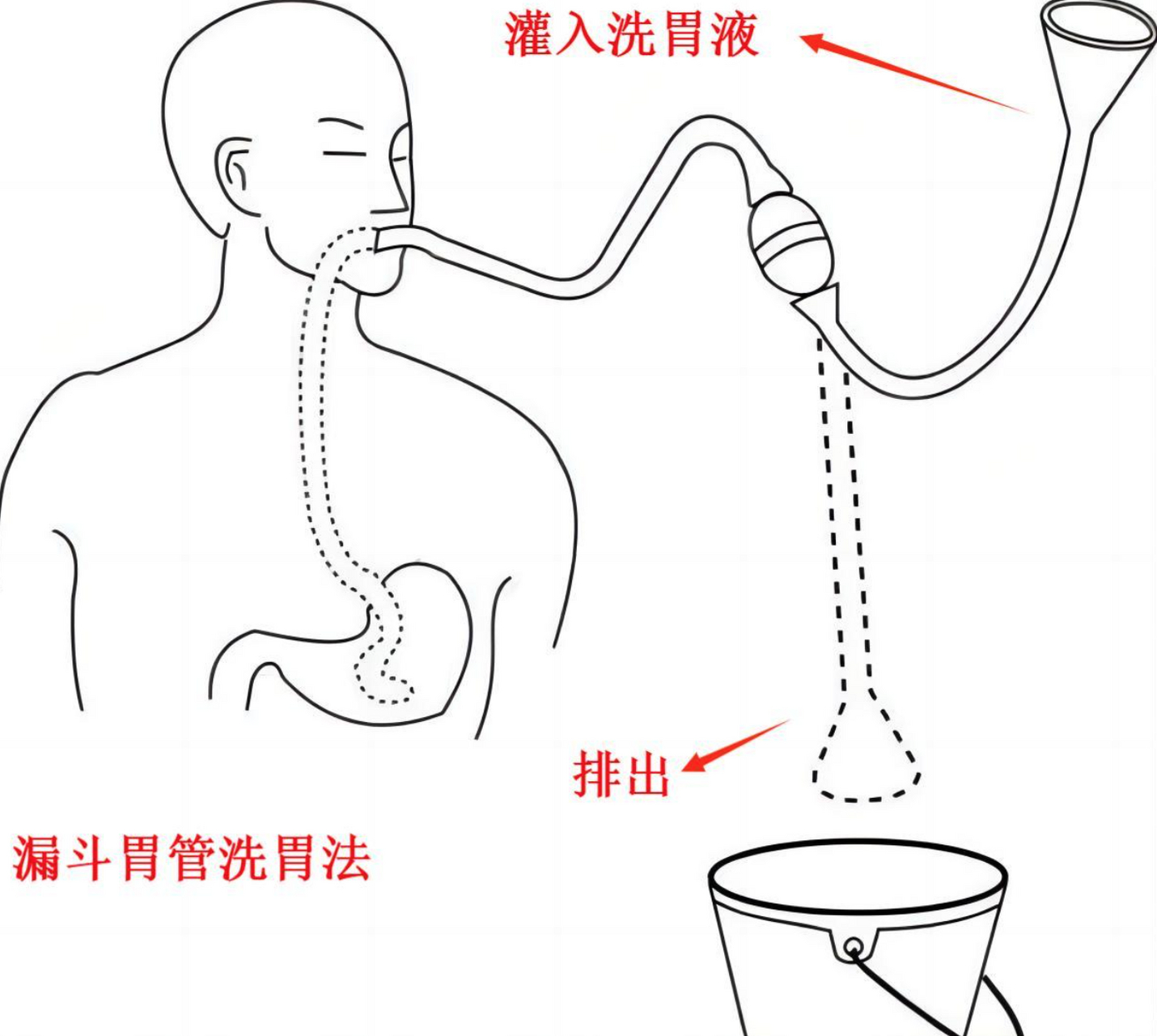 洗胃姿势图片