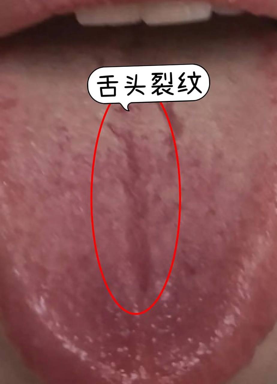 家长提问:我家孩子舌头有裂纹,嘴角反复起疱,补充维生素,效果也不佳