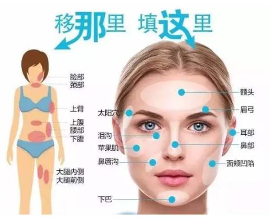 今天我来分享一下我的脂肪填充经验